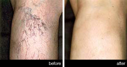 Sclerotherapy – Legs