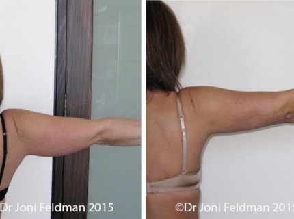 Arm Liposuction by Dr Joni Feldman in Melbourne