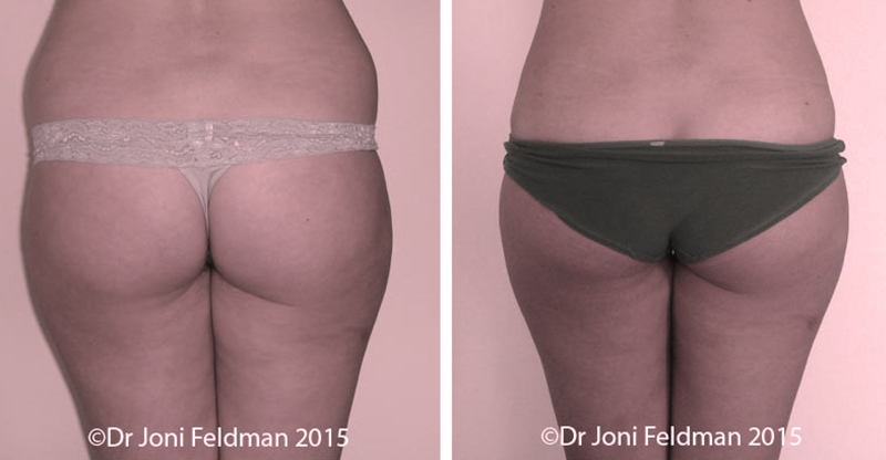 hips liposuction - before and after