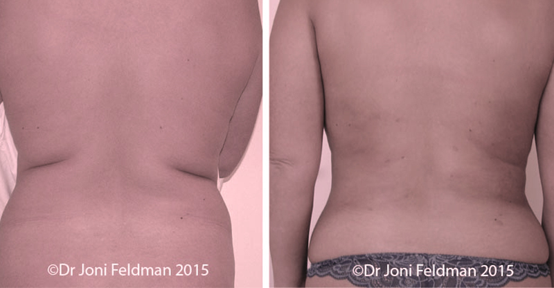 waist liposuction - before and after pictures