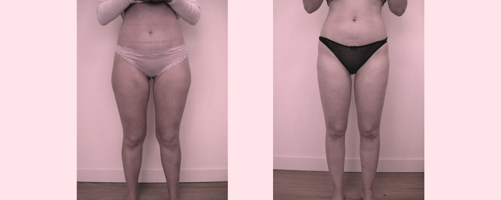 before-after-thigh-knee-liposuction in Melbourne