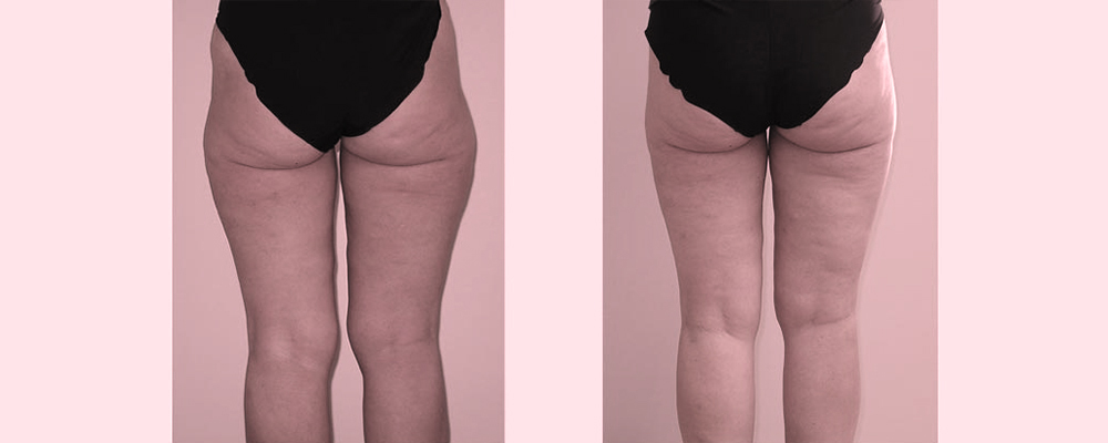 before-after-thigh-knee-liposuction