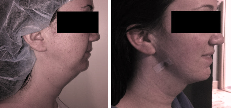 liposuction-chin - neck before after photo
