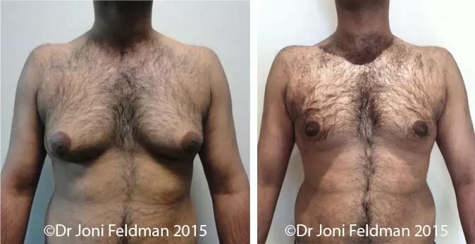 Why Are More Men Choosing Gynecomastia Surgery (Male Breast