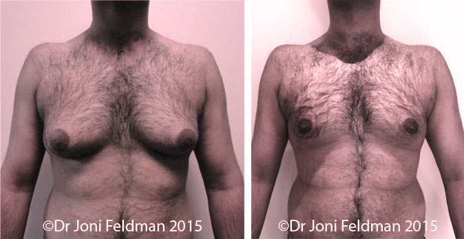 liposuction for man-boobs orgynaecomastia