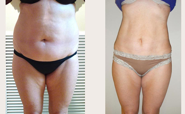 tummy liposuction Stomach Liposuction Before and After